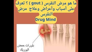 ما هو مرض النقرس ( gout ) ؟ تعرف على أسباب وأعراض وعلاج مرض النقرس .  Drug Mind