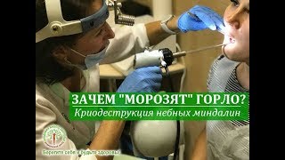 Криодеструкция (криолечение) миндалин в Киеве