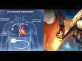 Chambre implantable de perfusion port a cath mise en place chirurgicale animation