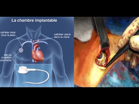 Chambre implantable de perfusion port a cath mise en place chirurgicale animation