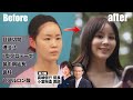 【※手術映像あり】美しくなりたいけど自然さ重視!ナチュラル整形で理想の目と鼻に【真崎医院の美容整形】