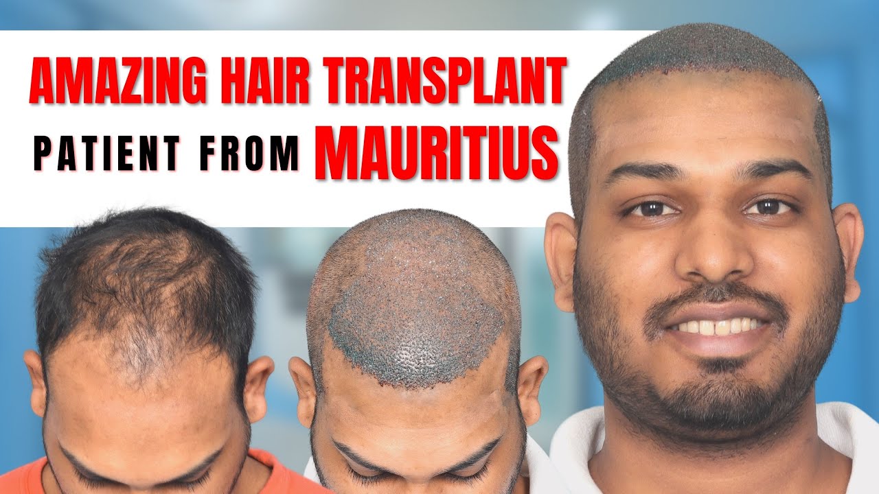 Hair Transplant in Mauritius Best Results & Cost of Hair Transplant