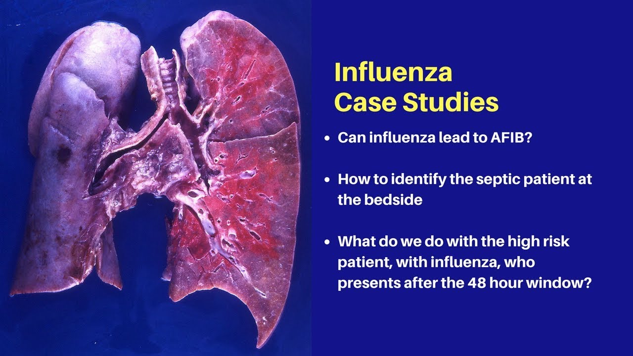 influenza what you need to know for 2018 youtube
