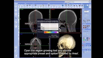 Coloring airways using Region Growing tool in Planmeca Romexis® 3D module