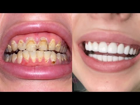 Wideo: 5 sposobów na naprawę krzywych zębów