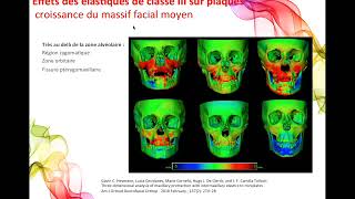 Traitement orthopédique de classe III sur ancrage osseux : mini-vis &amp;  plaques de Declerk