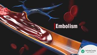 WhiteCoats | Medical Insights | Management Of Embolism