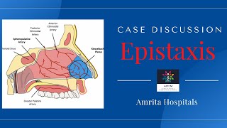 Epistaxis || Case Discussion