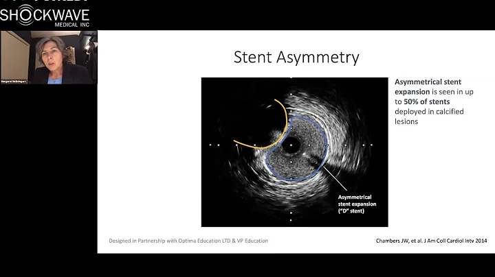 Assessment and Management of Calcified Coronary Lesions, Eccentric Calcium Workshop Part 1/5