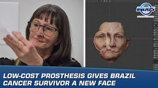 Low-Cost Prosthesis Gives Brazil Cancer Survivor A New Face Indus News