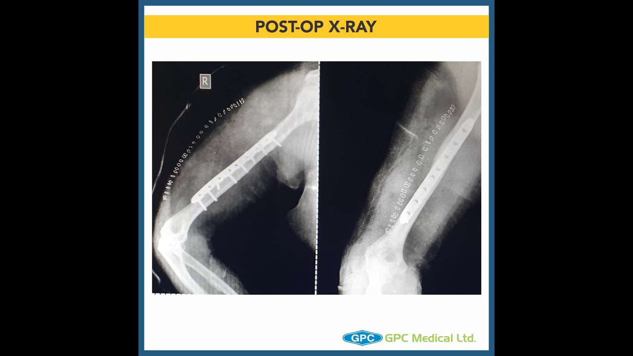 Midshaft Humerus Fracture Operate or Treat Conservatively GAITS