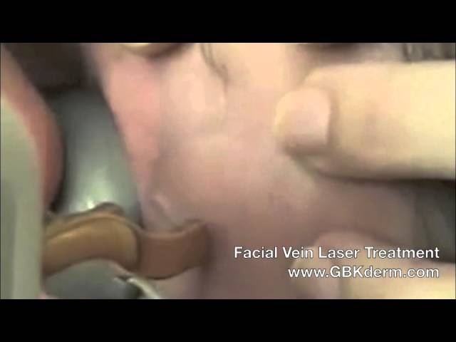 Banner for Facial Vein Treatment | Laser Vein Therapy | San Diego