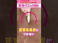 実践!液体イボコロリの上手な塗布法!! #shorts #皮膚科 #しのぶ先生