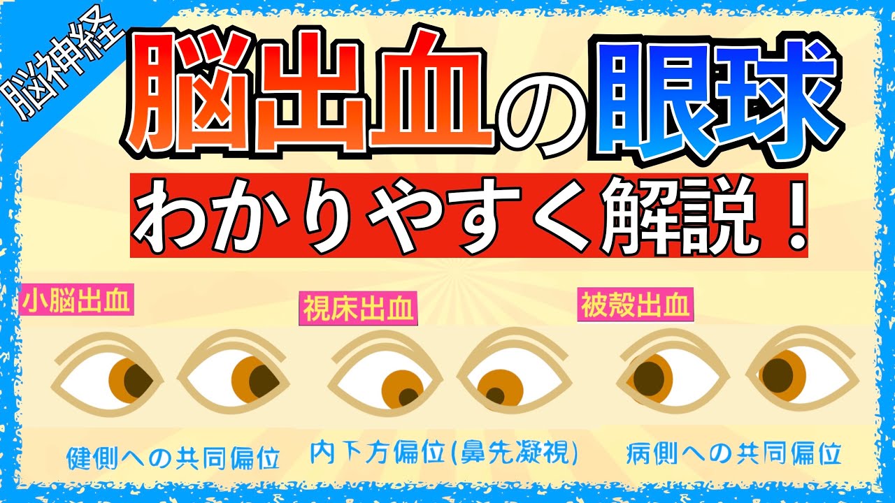 イラストで学ぶ医学！「脳出血の眼球症状まとめ」被殻出血で病側に共同偏視が起こる理由/小脳出血で健側に共同偏視が起こる理由/PPRF