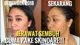 CARA MENGHILANGKAN JERAWAT HANYA MENGGUNAKAN SKINCARE (UPDATE SKINCARE ROUTINE   PRAKTEK)