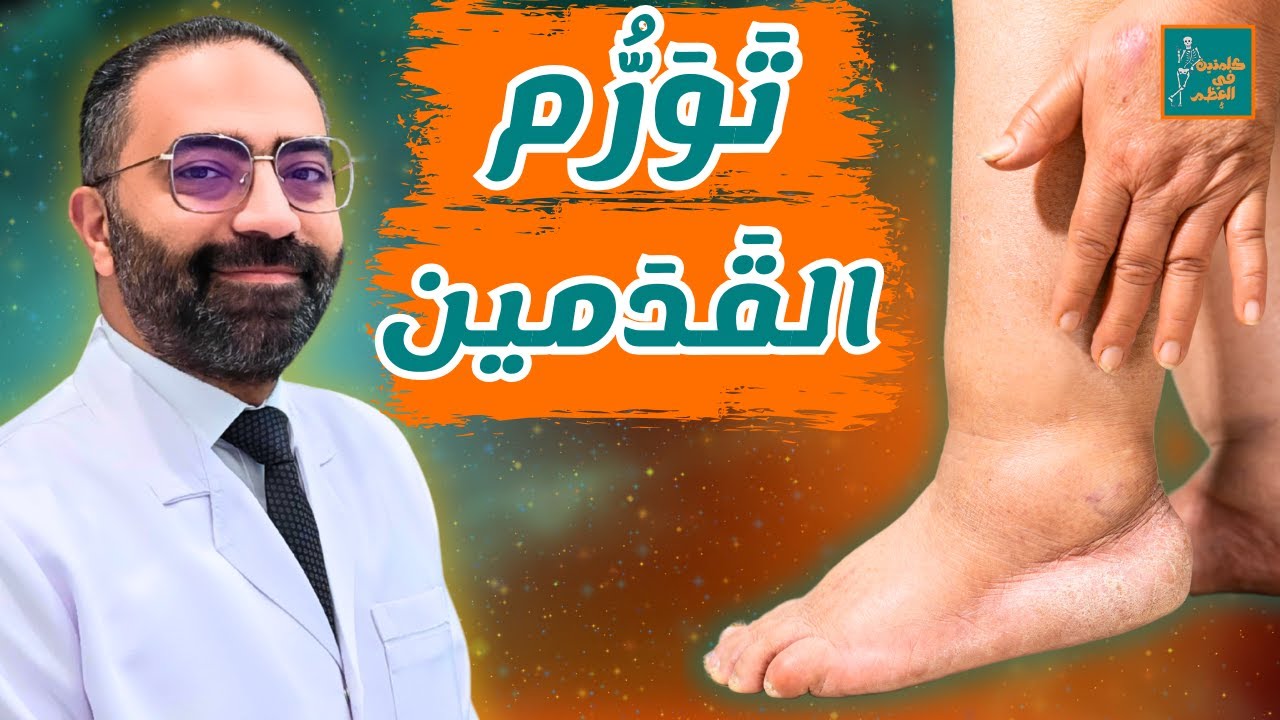 ليه رجلك بتورم؟ أهم 10 أسباب!