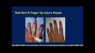 Finger tip injury repair with plastic surgery @bembdeplasticcosmeticburns7076 #fingertipinjuryrepair screenshot 3