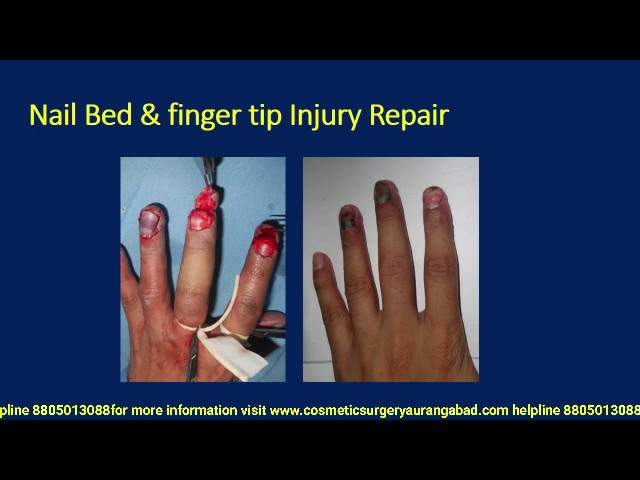Nail Bed Repair | Nail bed, Repair, Orthopedic surgery