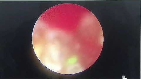 Hậu quả sỏi niệu quản để lâu ngày và cách xử lý.7/10/2020.TTƯT.TS.BS.Dương Văn Trung☎️ 0913534343