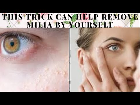Using This Trick Can Help to Remove Milia by Yourself - HEALTH OAK