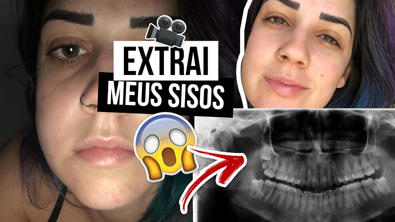 COMO FOI TIRAR OS SISOS? O que comer? Inchaço, roxo e dor.. Mariana ...