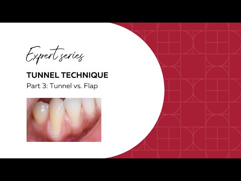 Gingival recession: tunnel or flap technique? | Deppeler's Expert series | Periodontal Surgery - video from Deppeler