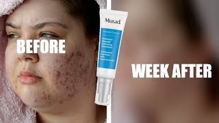 dr murad acne control