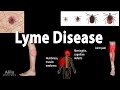 Lyme Disease, Animation