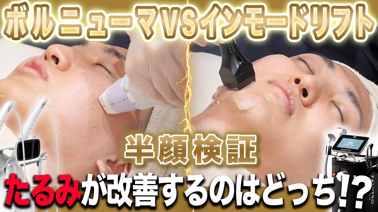 たるみ改善するのはどっち？インモードリフトとボルニューマで半顔検証してみた！
