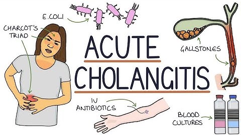 Acute cholangitis | Drk