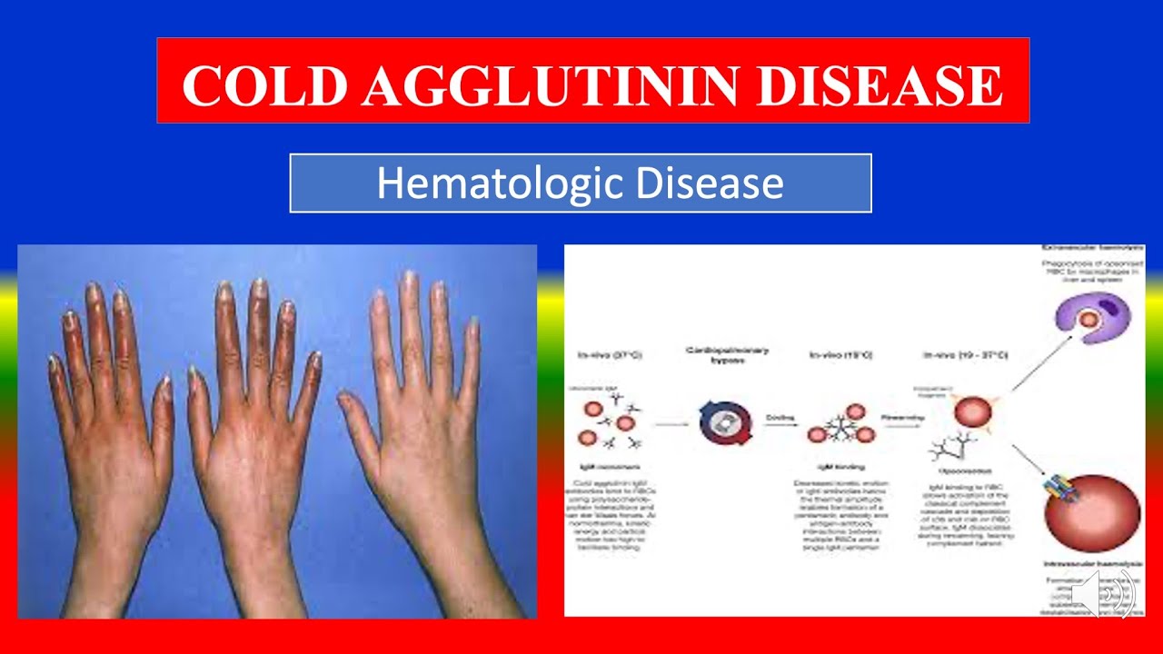 COLD AGGLUTININ DISEASE -Definition, types, causes, pathophysiology ...