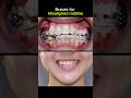 Braces for misaligned midline #braces #orthodontist #dentist #teeth