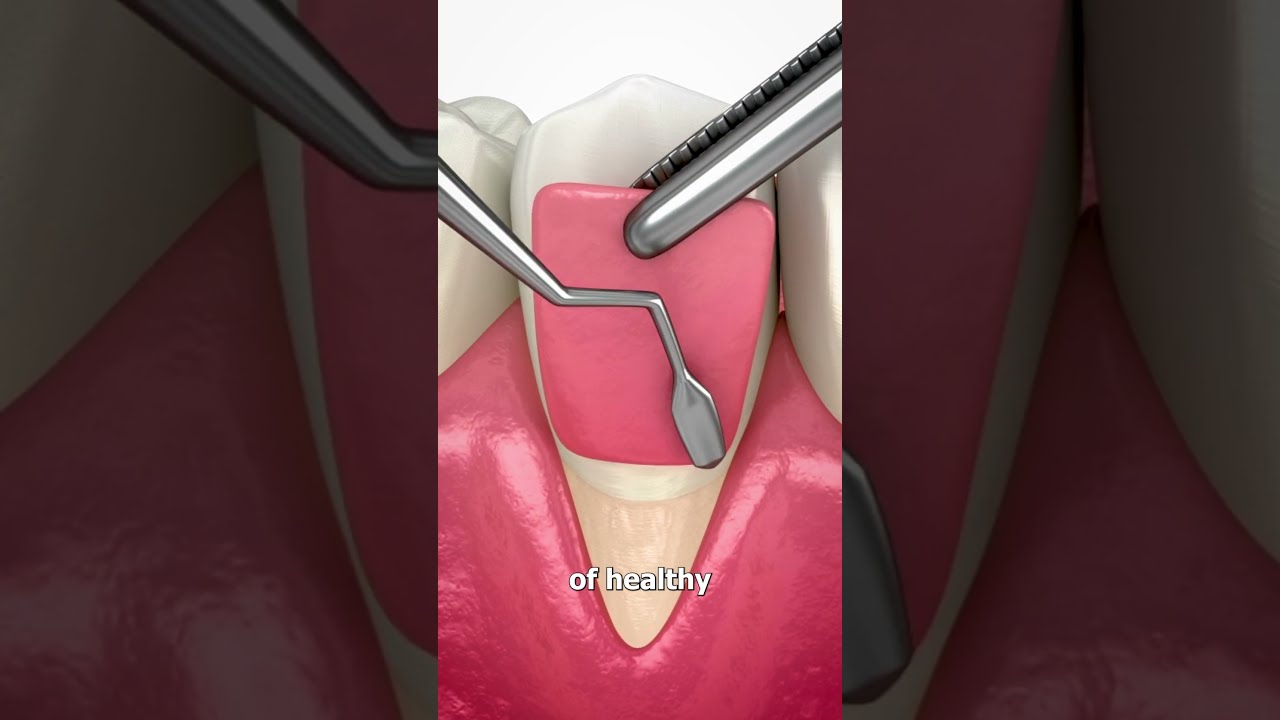 How They Fix Messed Up Gums 