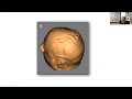 Strategies for Add-On Therapies for Individuals Using BoNT -- Dystonia Coalition 2022
