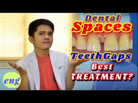 DENTAL SPACES AND GAPS: Treatments|REVEALED and EXPLAINED!