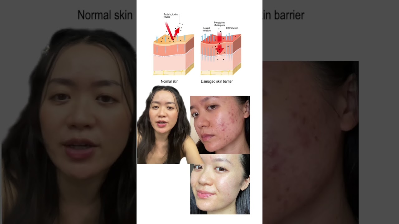 Heal your skin barrier before treating your acne! 