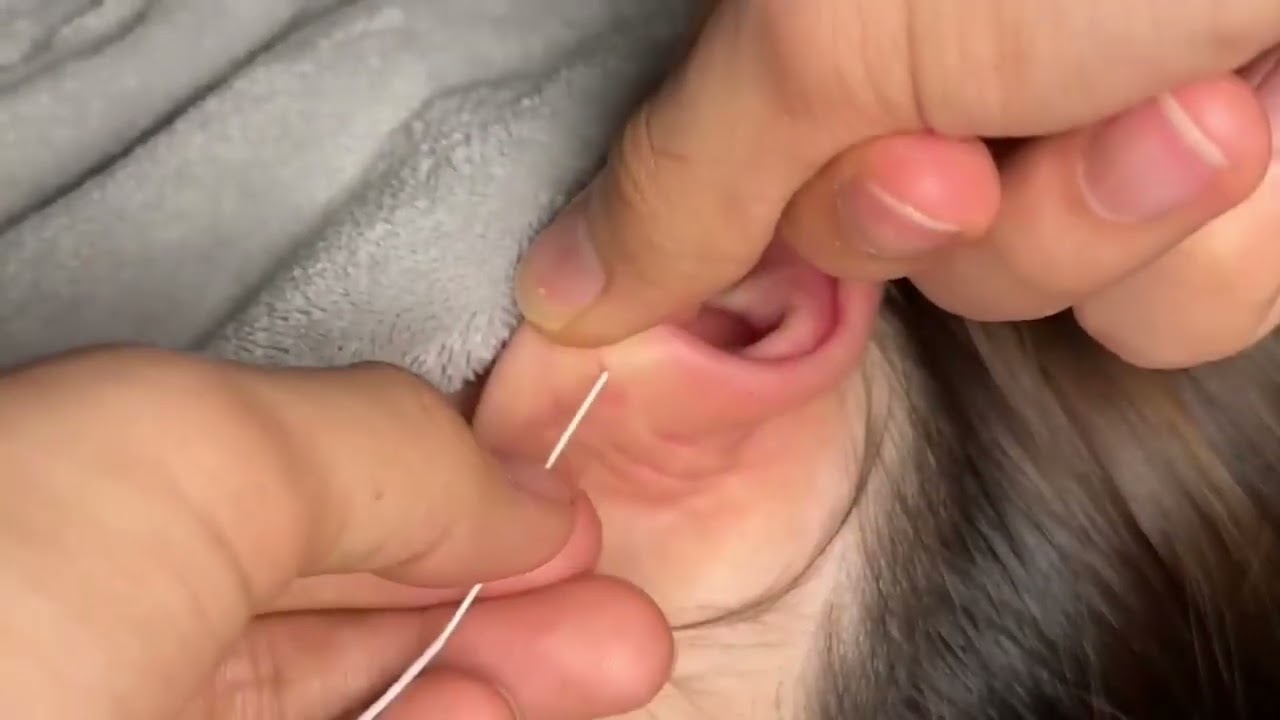 ASMR Earwax Removal | Hypnotic Black Cotton Swab Cleaning 