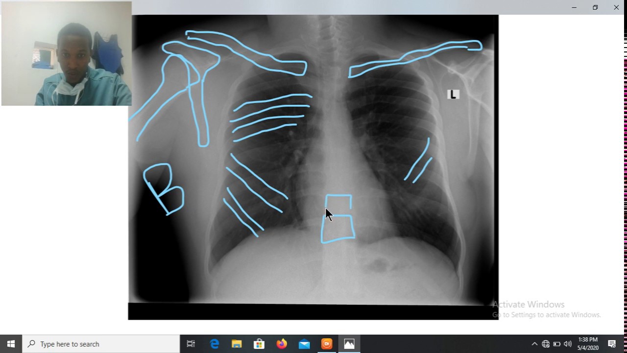 How to read Chest Xray (Final Part) YouTube