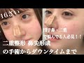 【整形】二重整形・鼻尖形成・ダウンタイムから完成まで