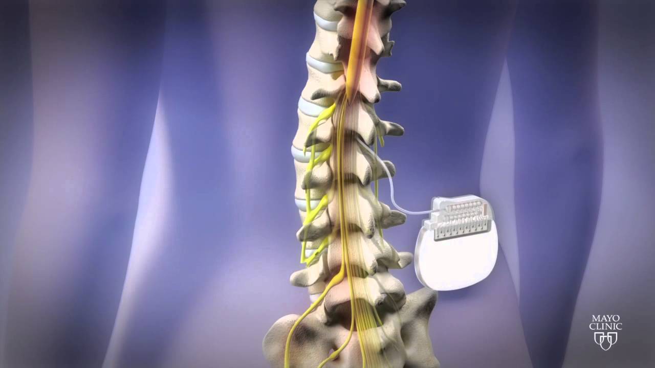 Spinal Cord Stimulation for Chronic Pain, Reduce Pain Medication