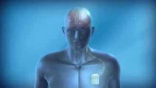 Medtronic DBS Man - Tech Oriented