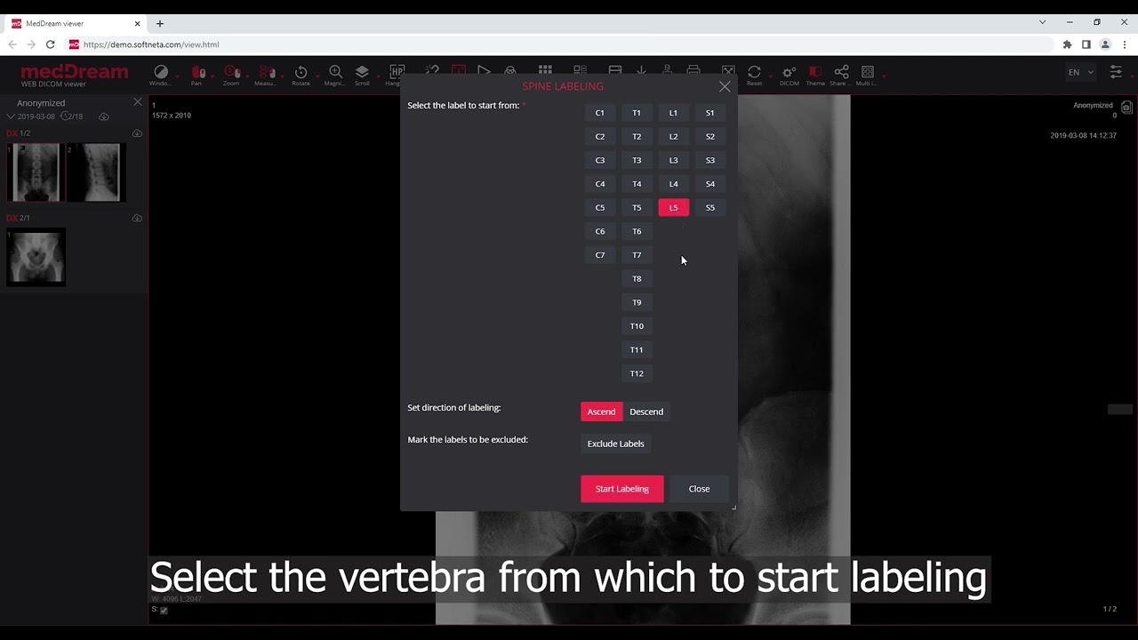 MedDream DICOM Viewer: spine labeling