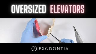 Another Approach To Elevating Teeth | OnlineExodontia.com
