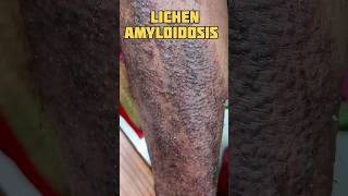 lichen Amyloidosis with LSC 😱 #shorts #shortsfeed #beautytips #doctorskin