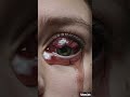 Panuveitis - The Worst Eye Infection