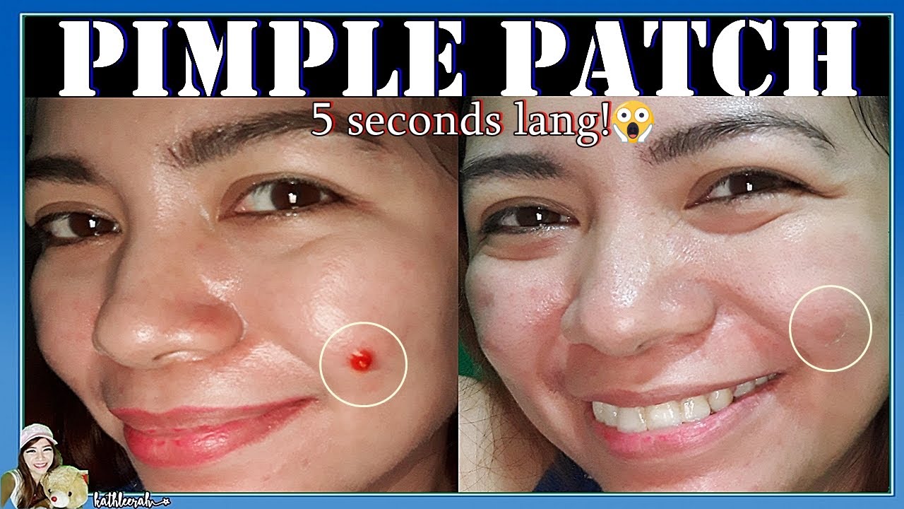 5 Seconds Lang? MIA CARE Pimple Patch Honest Review 