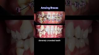 Braces process: Treatment for severe crowded teeth #braces #orthodontist #dentist #teeth