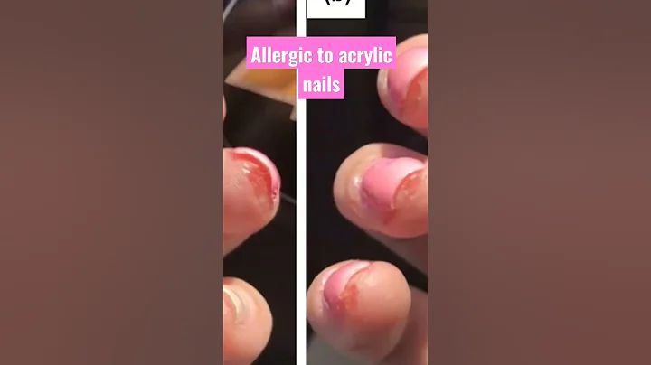 what to do if you get an allergic reaction 💕