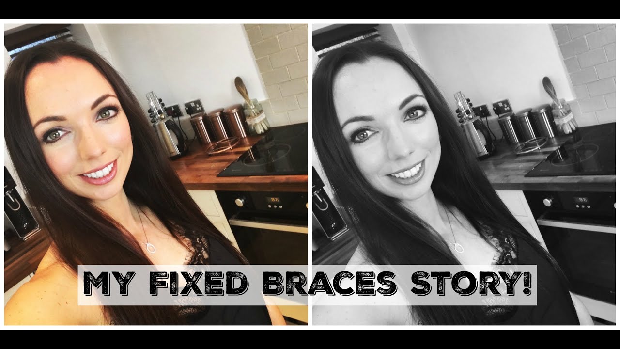 My Fixed Braces Story + Top Tips (as an adult!!) YouTube