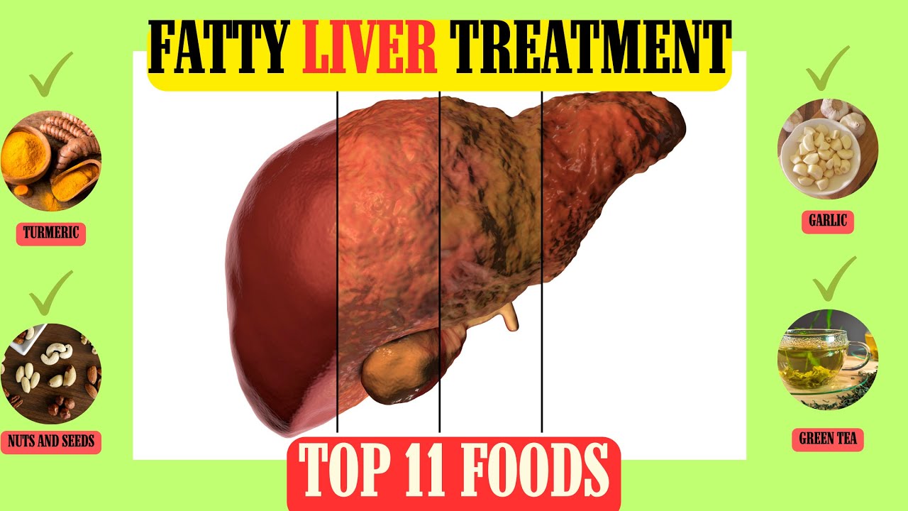 Top 11 Super foods to Clean or Detox your Fatty Liver - YouTube